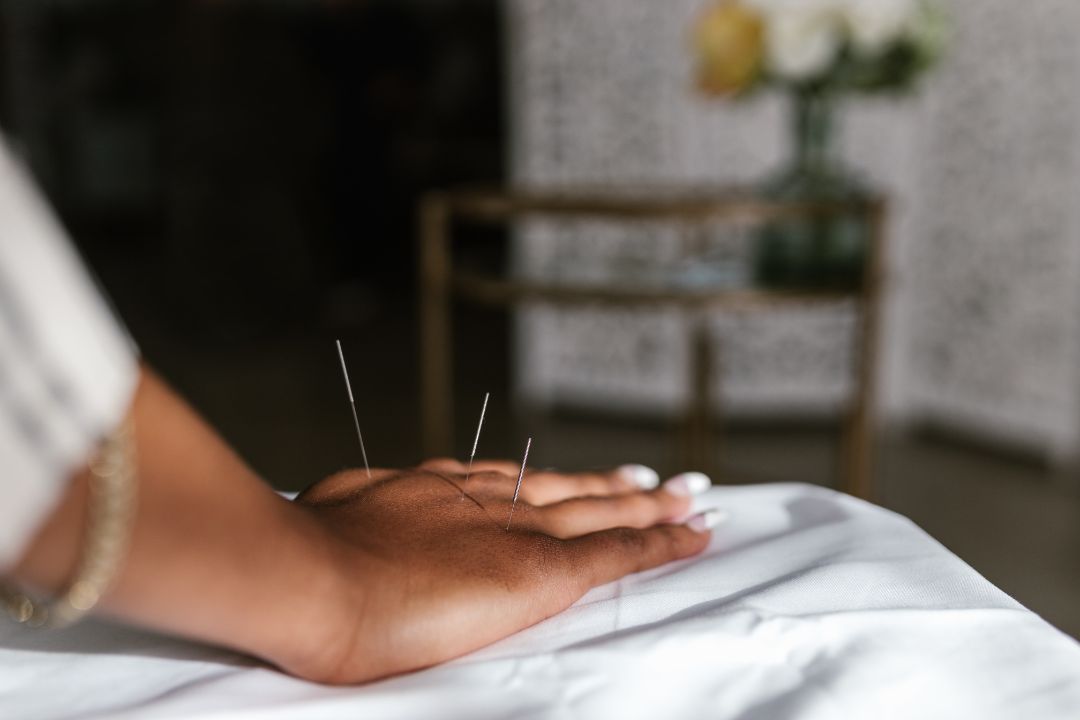 Community Acupuncture